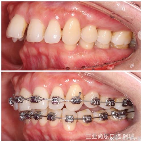 海南做牙齿矫正效果如何？价格贵不贵？哪家医院靠谱？-图3