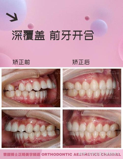 矫正牙齿和补牙,治疗顺序有讲究吗?-图1 矫正牙齿和补牙,治疗顺序有讲究吗?-图1