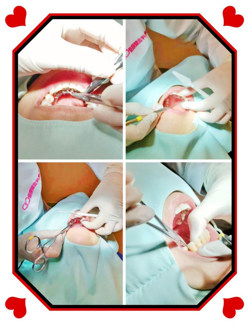 香港矫正牙齿，为何吸引内地人？需注意啥？-图1