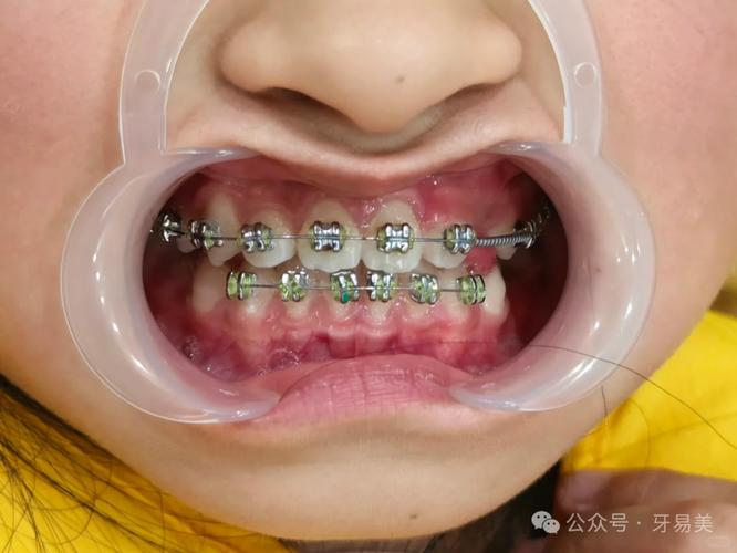 牙齿矫正换城市-图2