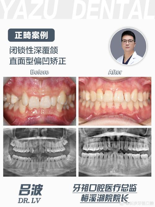 闭锁合牙齿矫正效果如何?矫正难点有哪些?-图3 闭锁合牙齿矫正效果如何?矫正难点有哪些?-图3