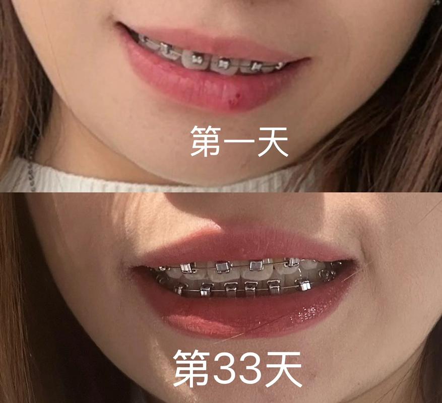 牙齿矫正拉牙缝-图1