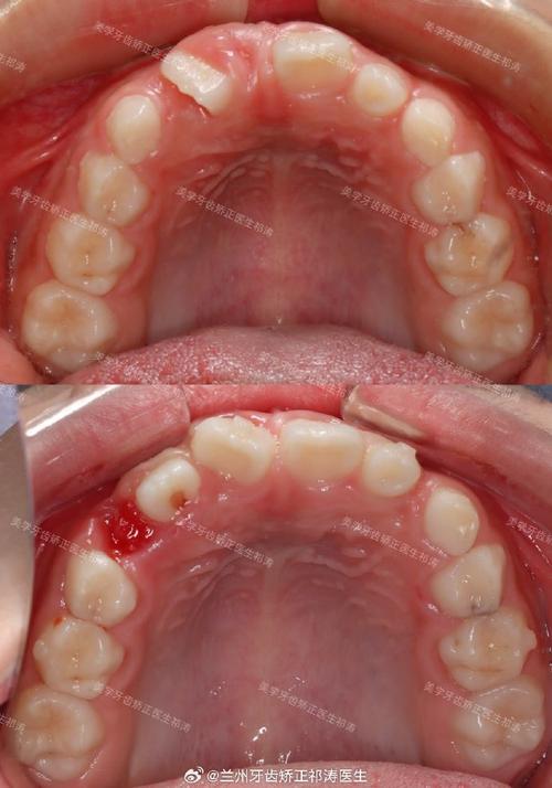 兰州市牙齿矫正-图1 兰州市牙齿矫正-图1