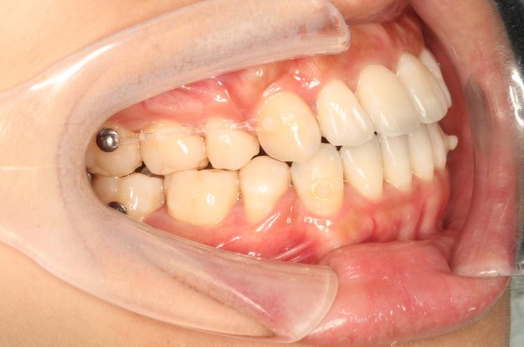 兰州市牙齿矫正-图2 兰州市牙齿矫正-图2