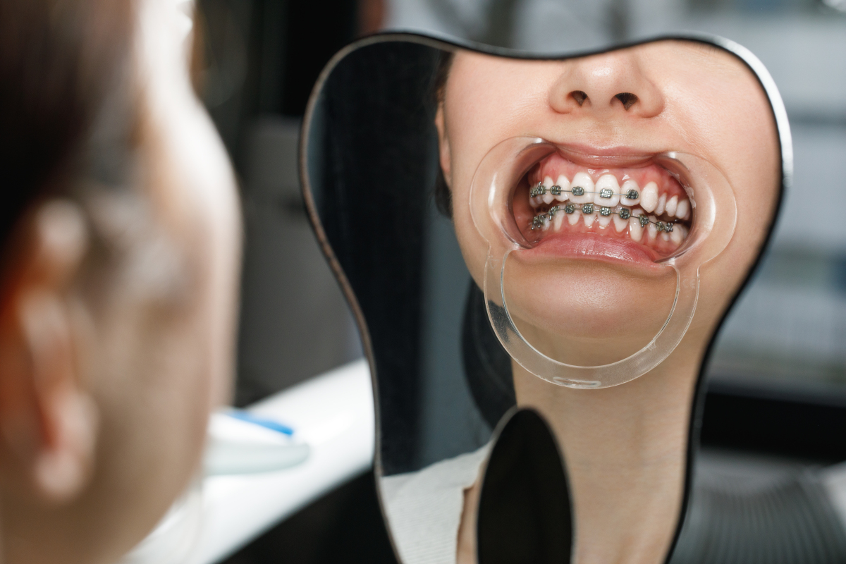 美国人矫正牙齿-图2