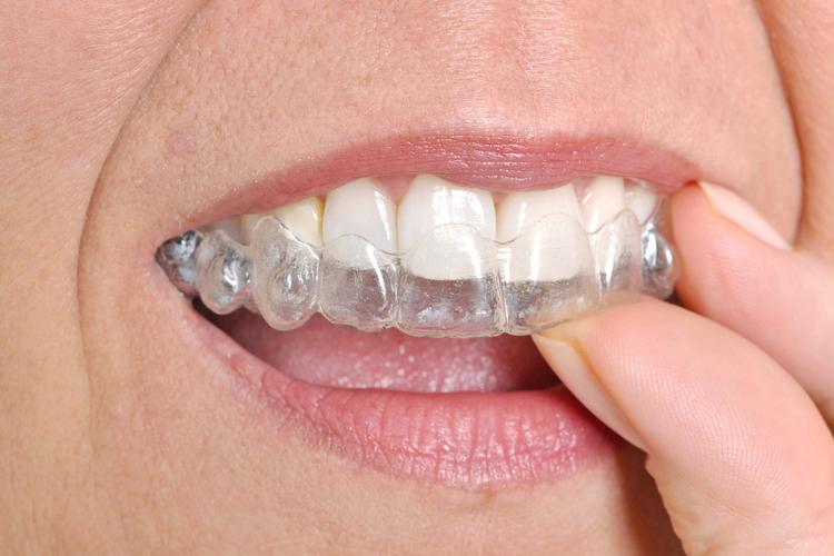 美国人矫正牙齿-图3