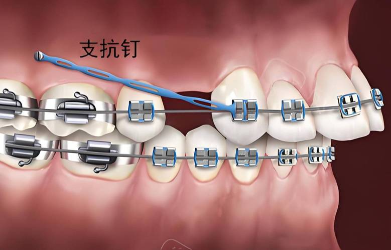 牙齿矫正打钢钉-图1 牙齿矫正打钢钉-图1