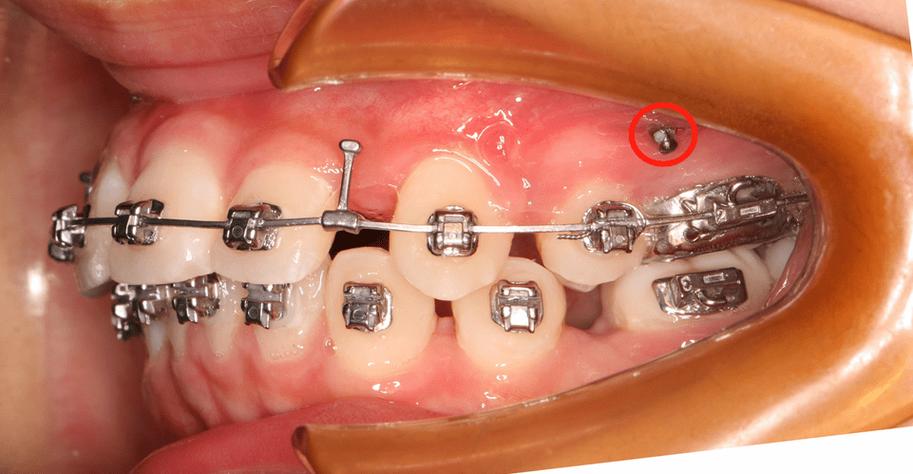 牙齿矫正打钢钉-图2 牙齿矫正打钢钉-图2