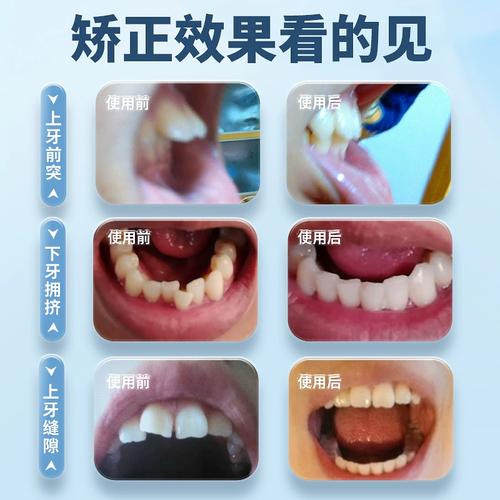 牙齿矫正要磨牙-图3