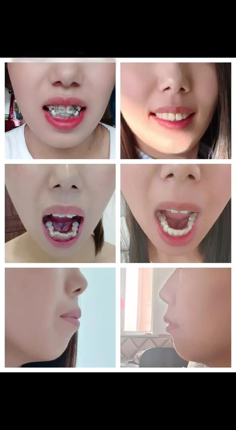 补牙后矫正牙齿，对牙齿健康有影响吗？-图1