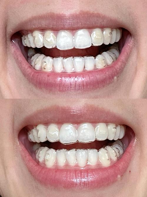 北京牙齿矫正效果怎么样？医院怎么选？价格贵不贵？-图2