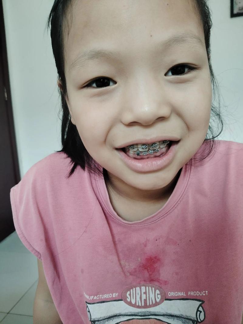 牙齿矫正3个月,矫正效果和变化如何?-图1 牙齿矫正3个月,矫正效果和变化如何?-图1