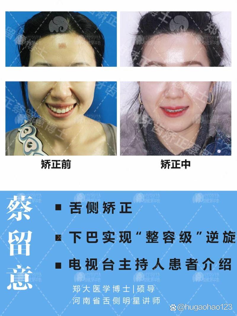 郑州牙齿矫正怎么选?医院靠谱、价格效果如何?-图2 郑州牙齿矫正怎么选?医院靠谱、价格效果如何?-图2