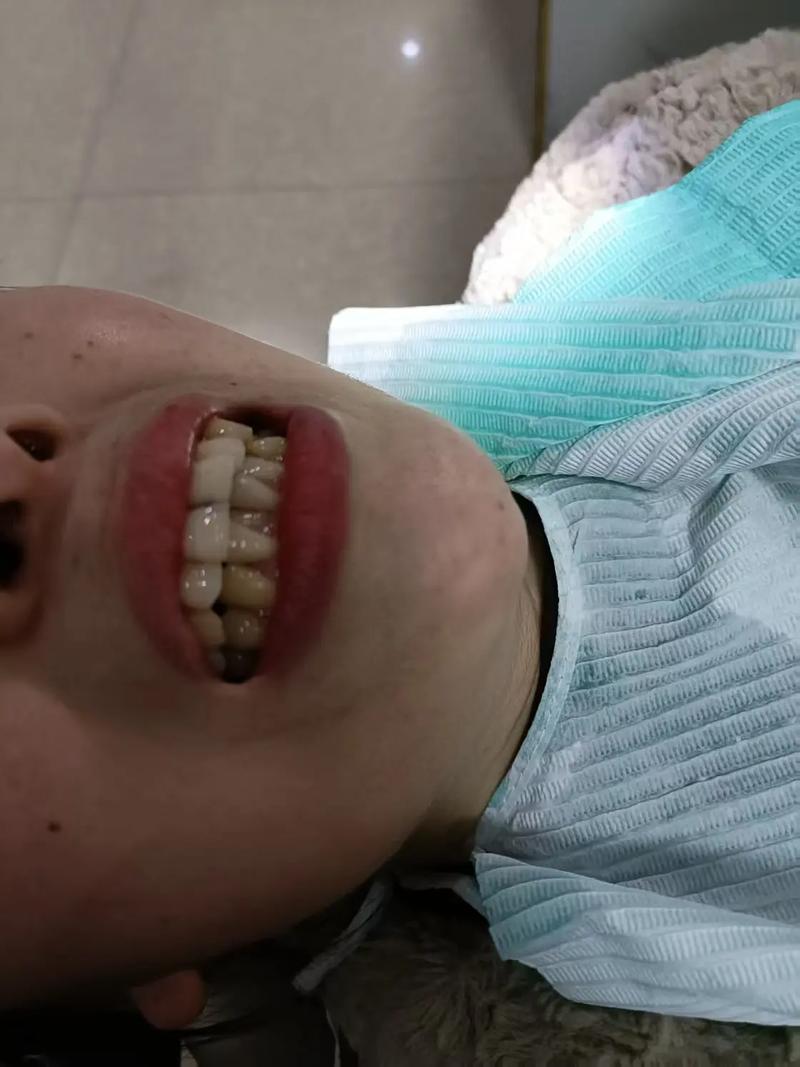 矫正牙齿后酸胀是正常现象吗？该如何缓解不适？-图3