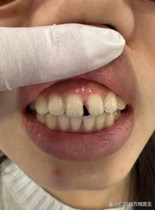 牙齿矫正后出现缝隙，是矫正效果问题还是正常现象？-图1