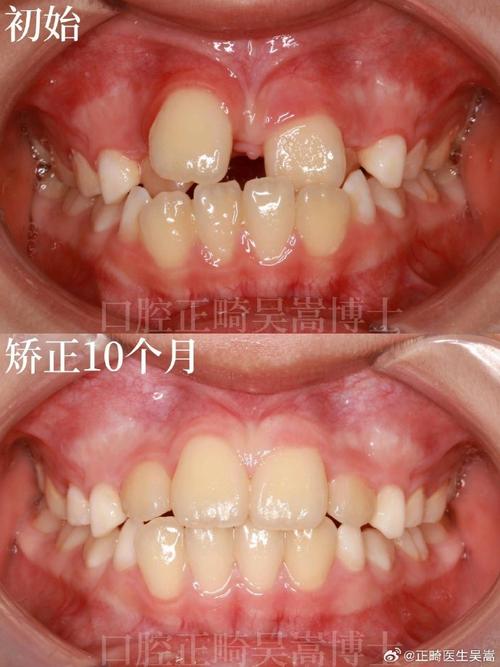 牙齿矫正后出现缝隙，是矫正效果问题还是正常现象？-图2