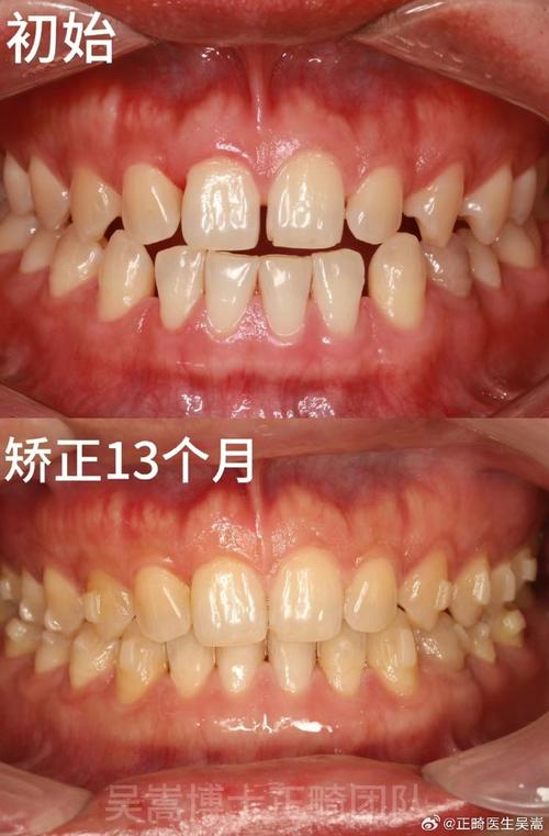 牙齿矫正后出现缝隙，是矫正效果问题还是正常现象？-图3