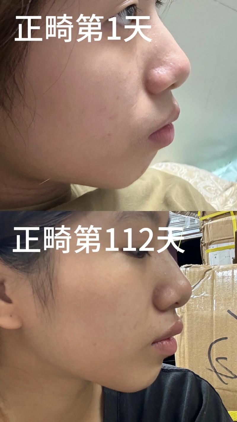 矫正牙齿后嘴变凸，是矫正方式问题还是必然结果？-图1