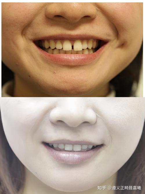 牙齿矫正为何要关缝隙？如何正确关闭？-图3