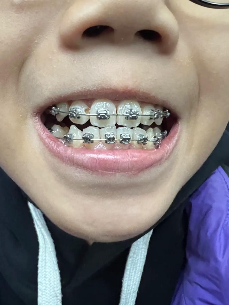 牙齿矫正不复查,牙齿会反弹吗?矫正效果会白费吗?-图3 牙齿矫正不复查,牙齿会反弹吗?矫正效果会白费吗?-图3